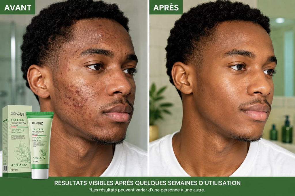 BIOAQUA™ - ANTI-ACNÉ